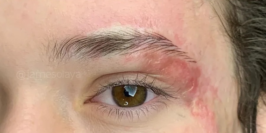 Sobrancelha depois do procedimento