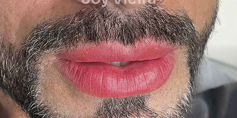 Lábios depois do procedimento