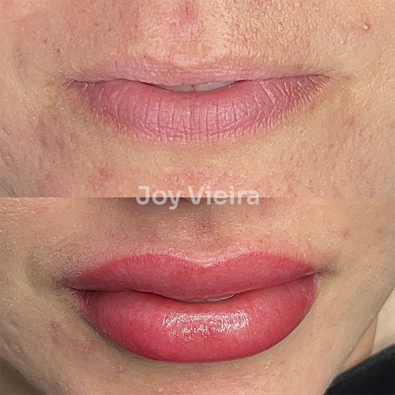 Resultado de micropigmentação labial