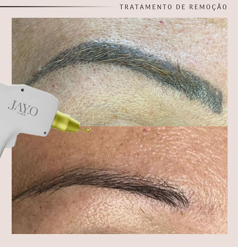 Antes e depois — remoção a laser