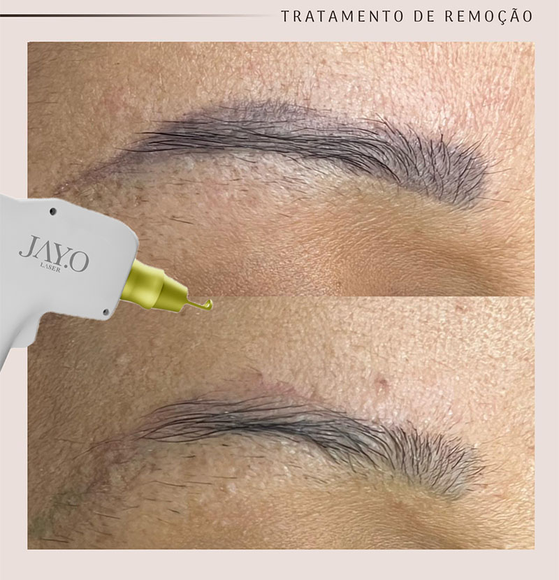 Antes e depois — remoção a laser
