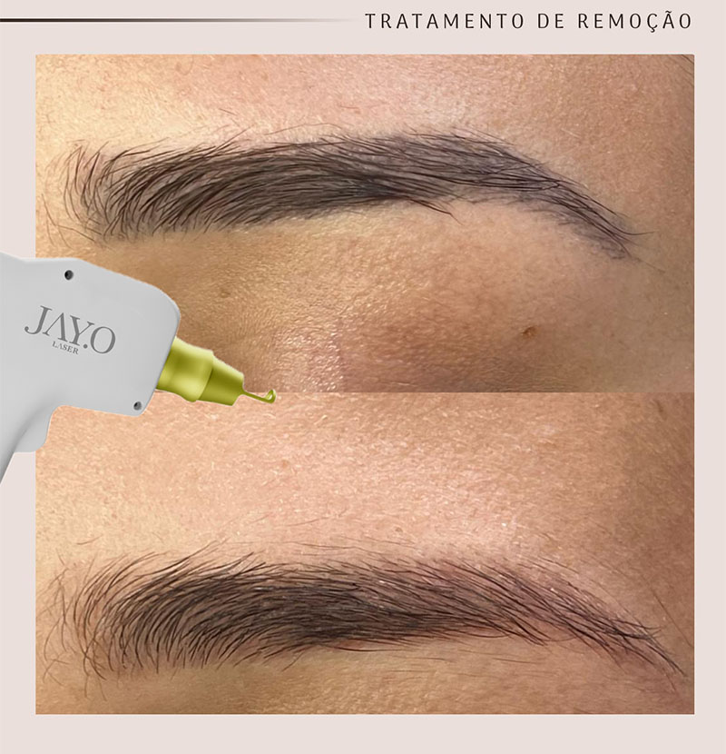 Antes e depois — remoção a laser