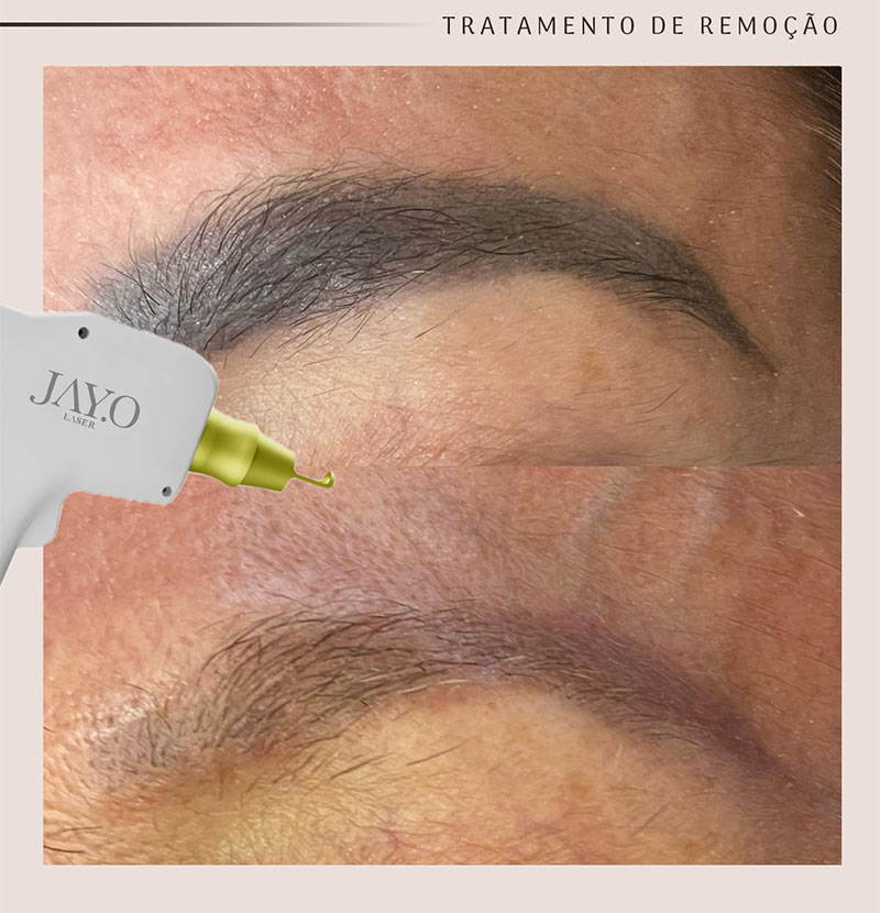 Antes e depois — remoção a laser