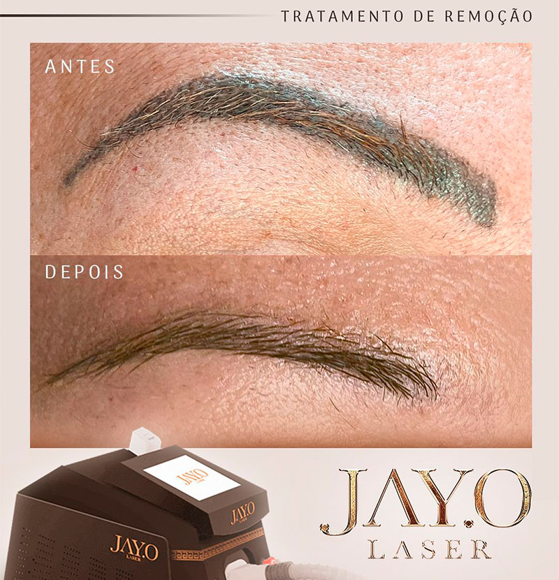 Antes e depois — remoção a laser