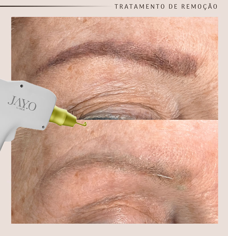 Antes e depois — remoção a laser