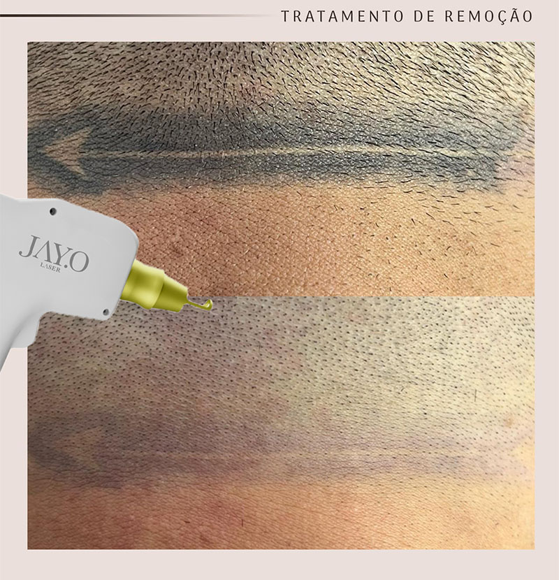 Antes e depois — remoção a laser