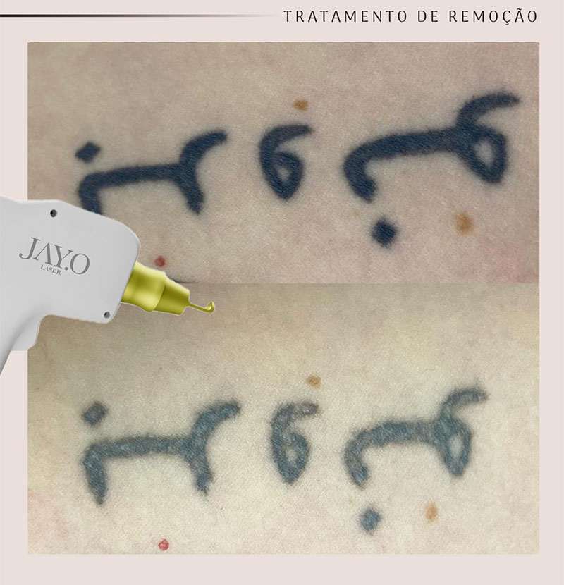 Antes e depois — remoção a laser