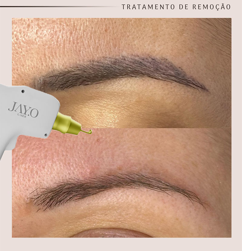 Antes e depois — remoção a laser